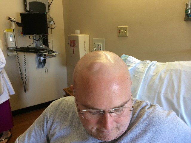 The bump on my head is a silicone disk connected to a tube that travels to the middle of my brain. Chemotherapy is instilled into the CSF (fluid) in the middle of the brain