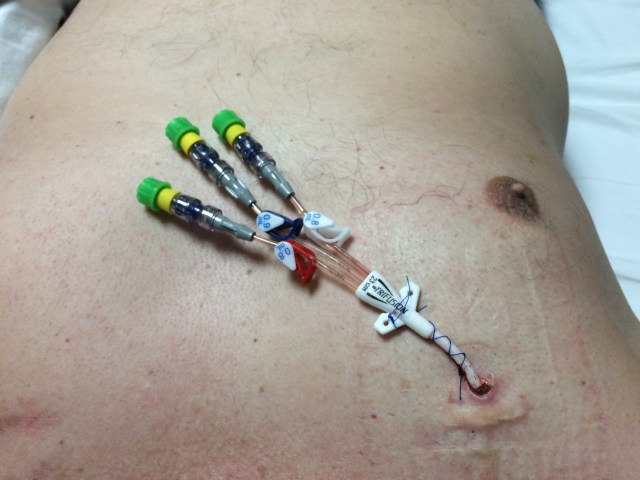 My Tri-Fusion Catheter during a dressing change. Now you know...